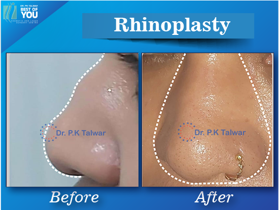 rhinoplasty surgery result